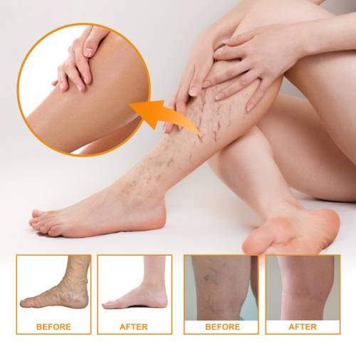 Benmassagecreme med vitamin K